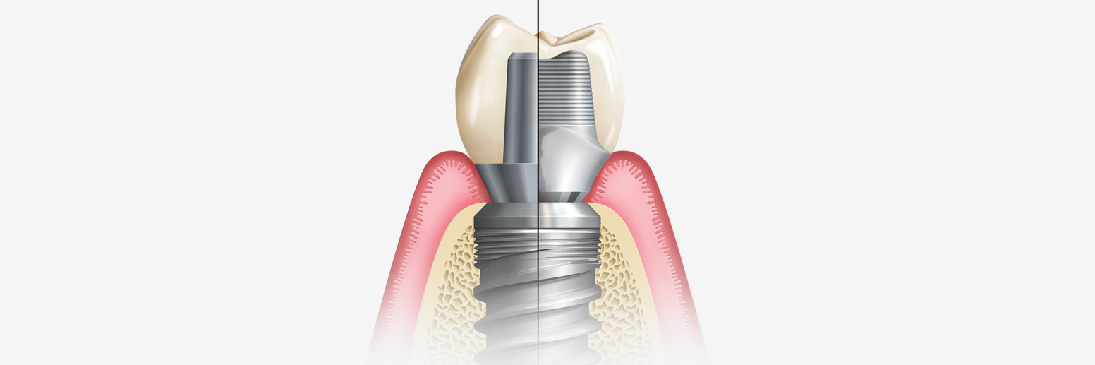 Custom Abutments vs. ScrewRetained Implant Crowns Glidewell