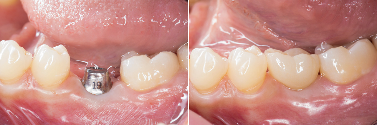 Before and after BruxZir Full-Strength Zirconia crown