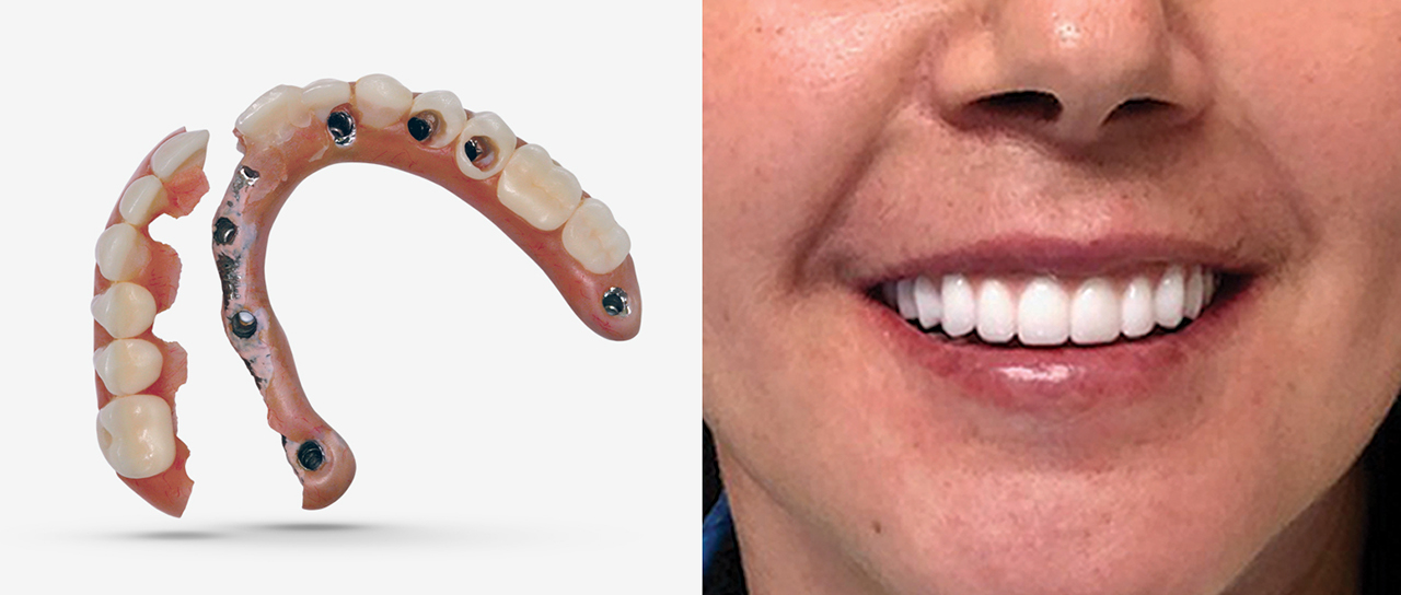 BruxZir Implant Prosthesis