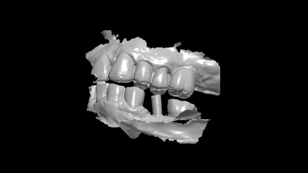 How Scanning Impacts the Final Restoration