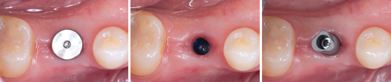 Tissue Collapse or Bleeding