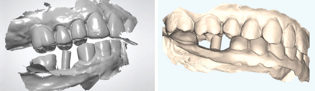 Missing Occlusion or Adjacent Structures