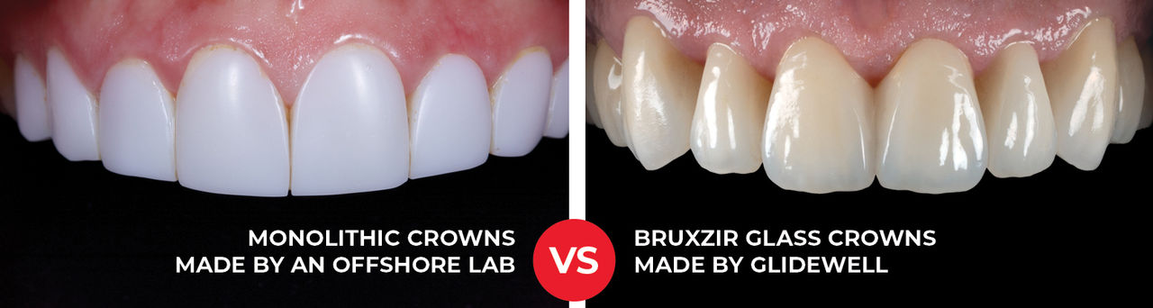 How-BruxZir-Glass-Compares-to-Other-Restorations