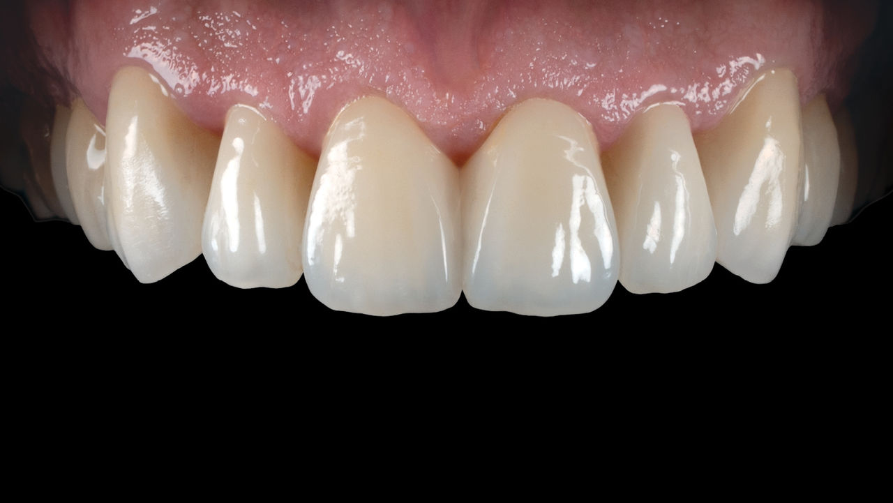 The-Benefits-of-BruxZir-Glass