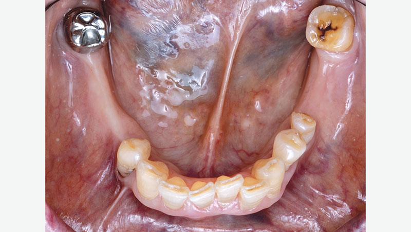 Original-crown-without-partial