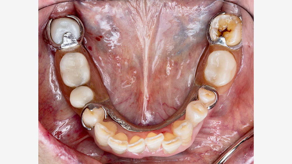 partial over final crown