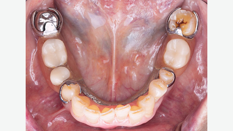 Partial-over-original-crown