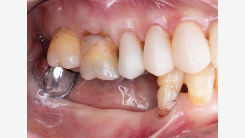 Occlusion-without-partial