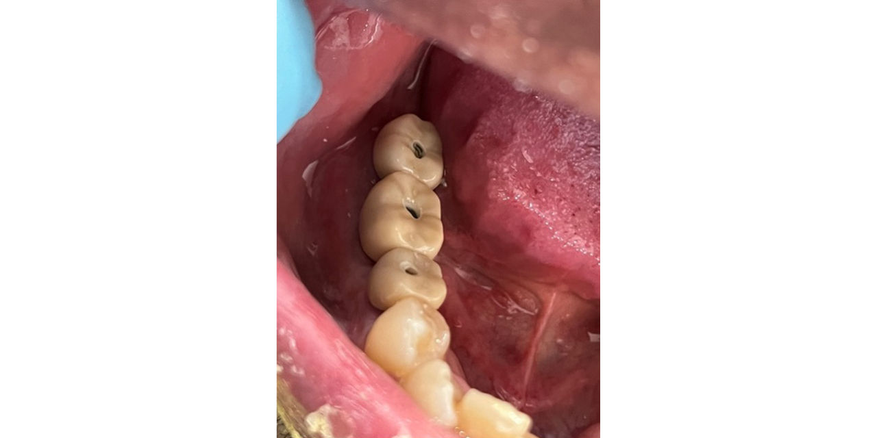 Clinical delivery of screwmentable restorations prior to sealing screw-access openings