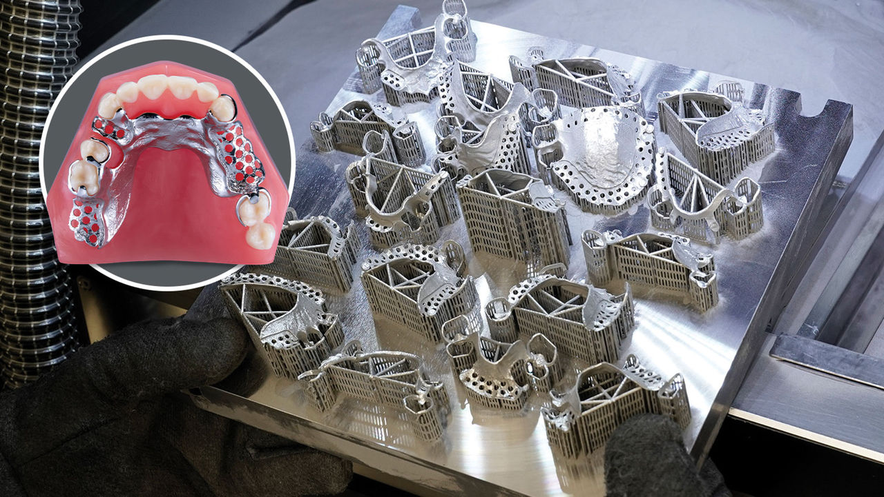 Revolutionizing Removables: SLM-Printed Metal Partial Dentures