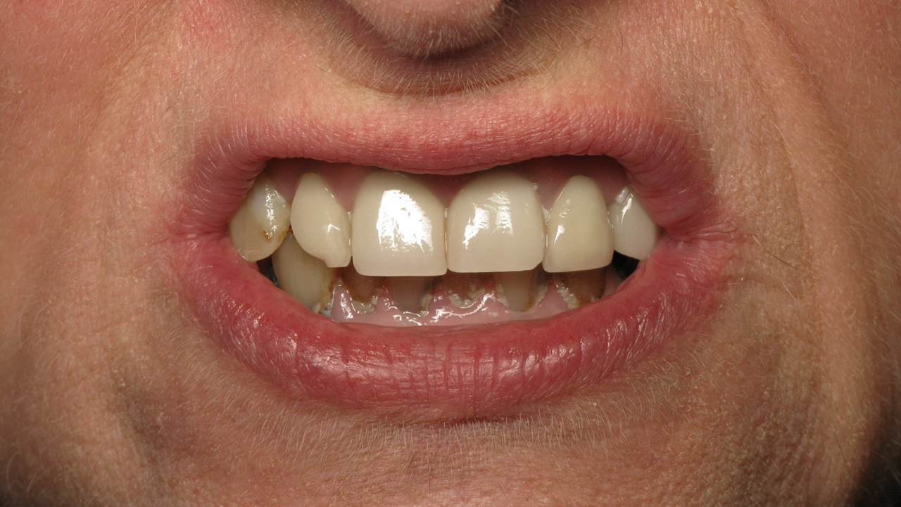 image of a patients teeth with terminal dentition