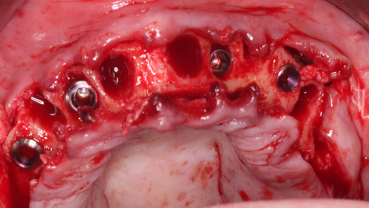 Hahn tapered implants inside extraction sockets of patients teeth post-removal