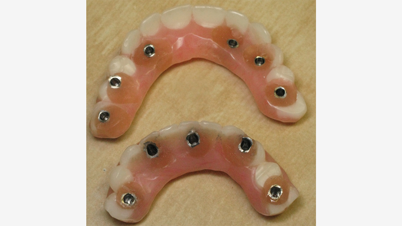 top and bottom view of immediate dentures