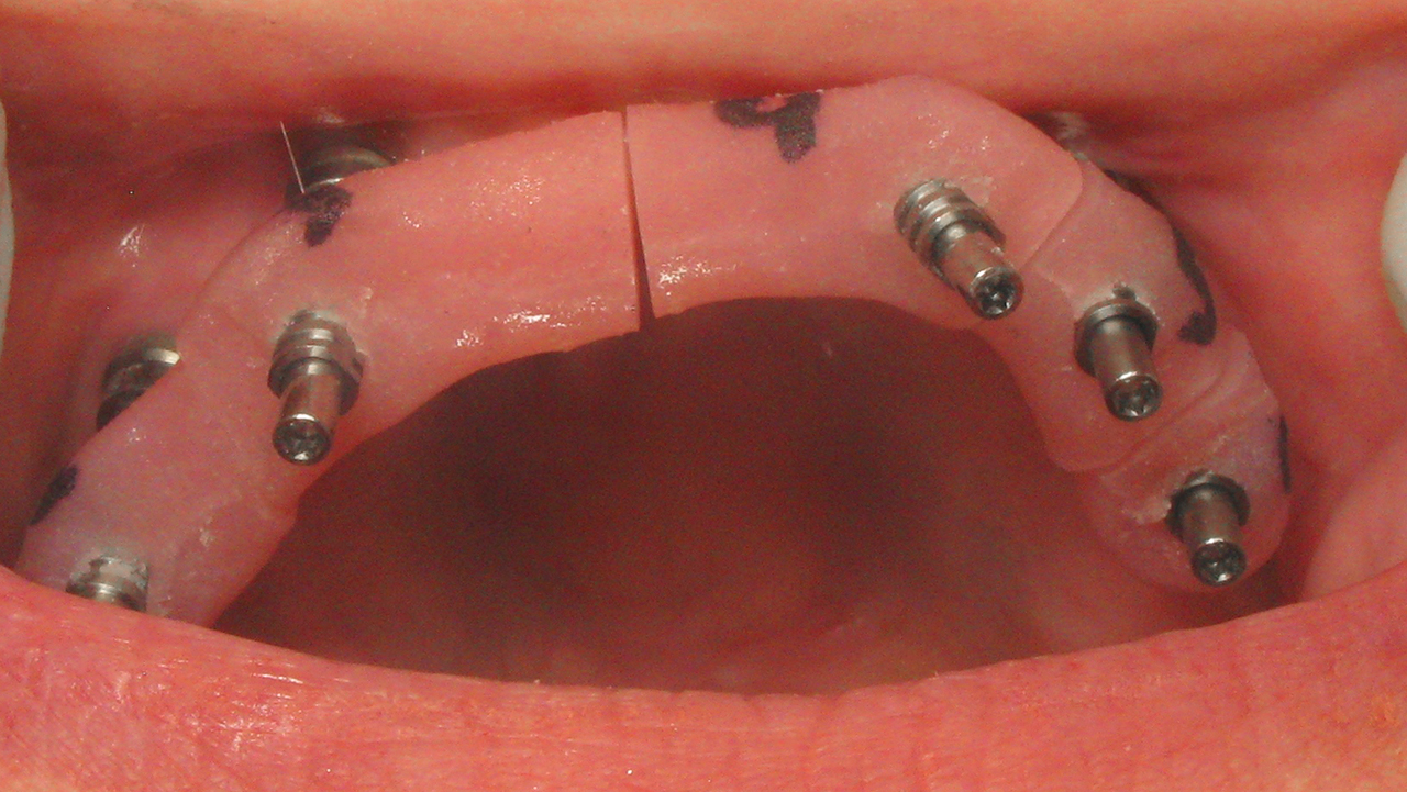 lab-provided implant verification jigs attached to multi-unit abutments