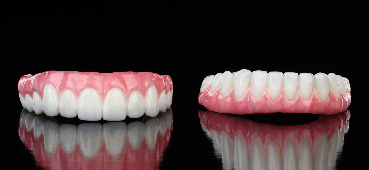 top and bottom 3d-printed provisional implant prosthesis