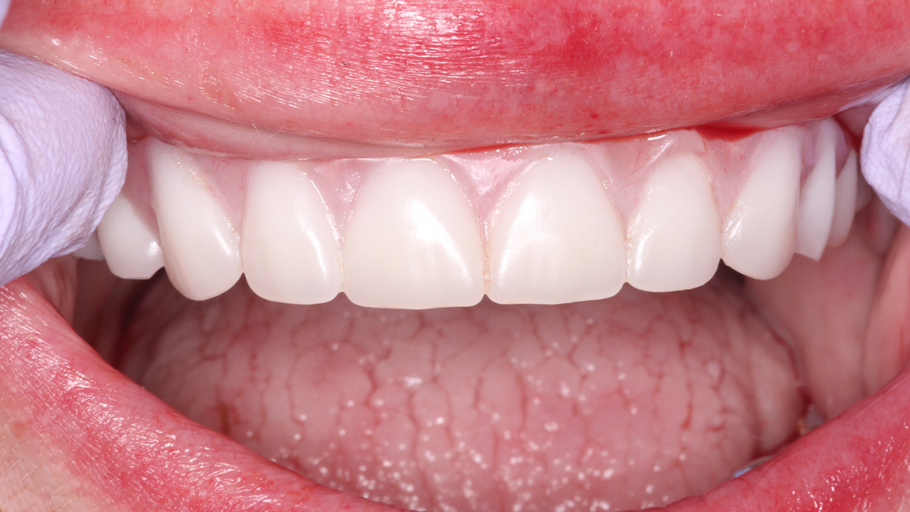 dentist fitting converted immediate dentures for a patient