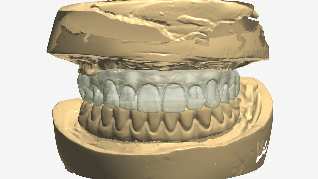 CAD scan of wax setups and master casts