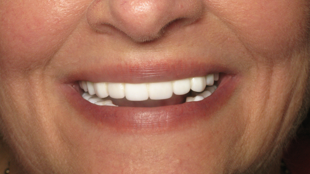 patient wearing provisional implant prosthesis before final milling