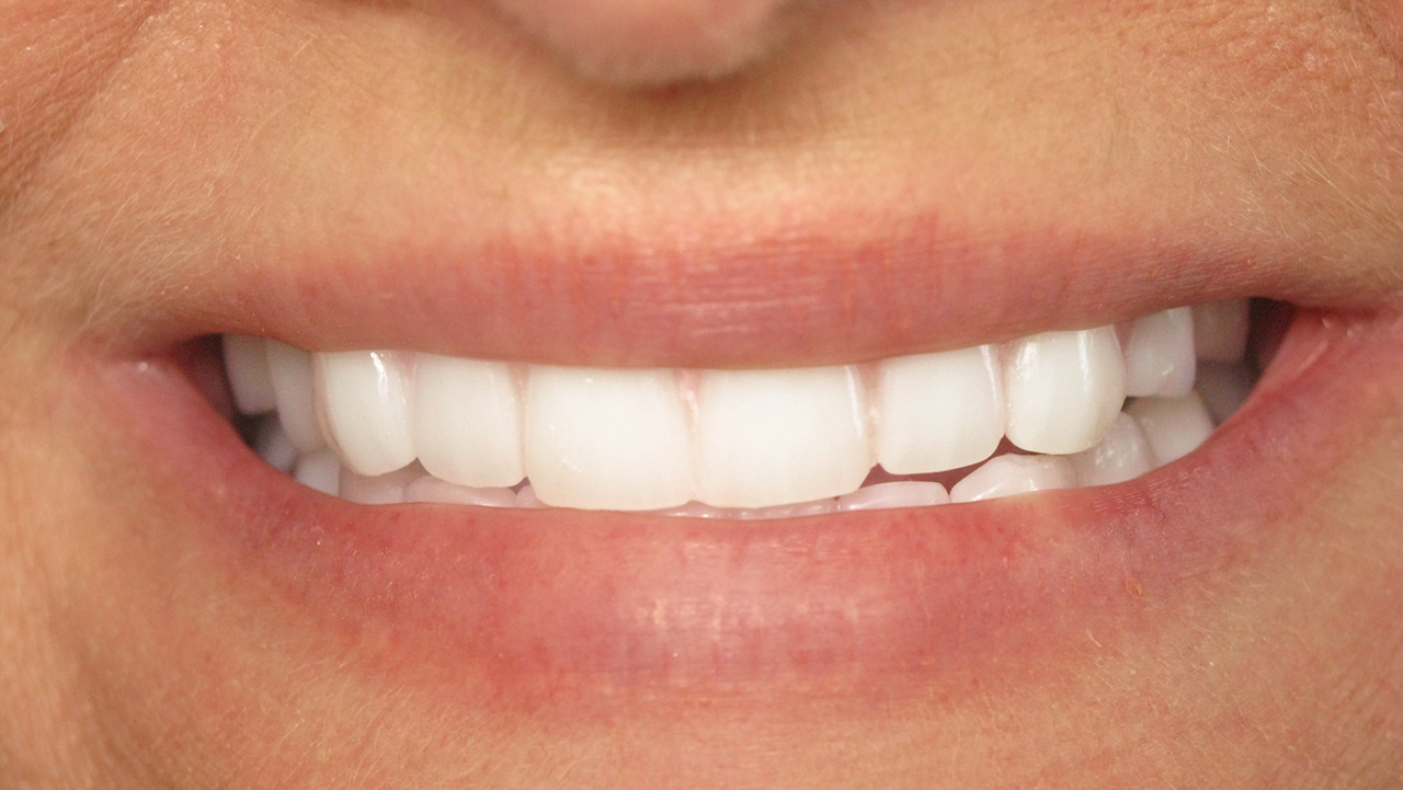patient testing wax setups for fit and accuracy