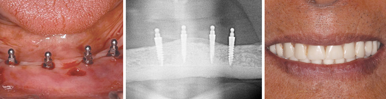 Small-diameter implant placement-