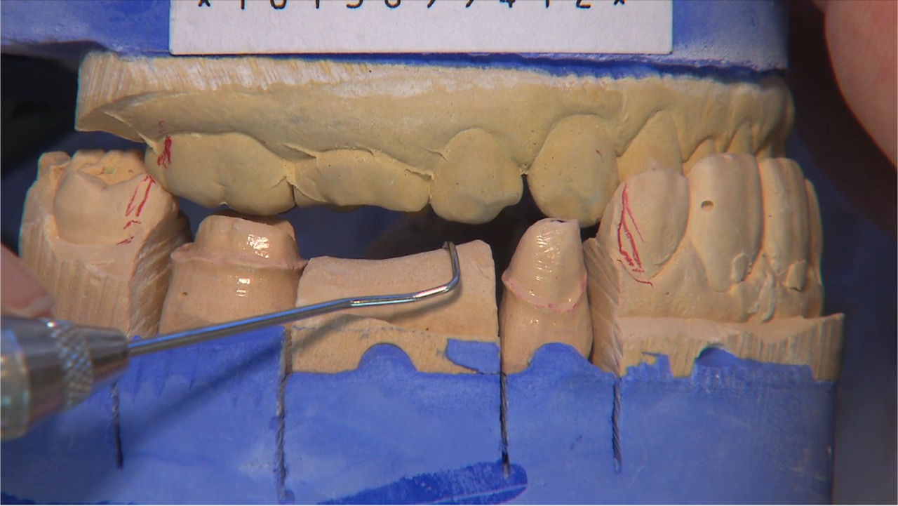 PFMs are a great solution for when there isn’t enough occlusal clearance for zirconia.
