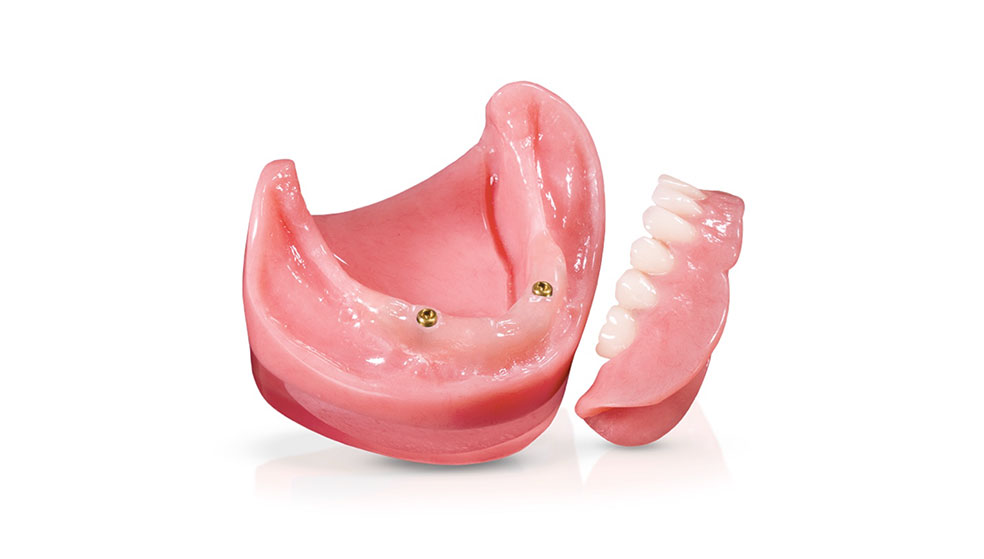 Implant-Retained Overdenture