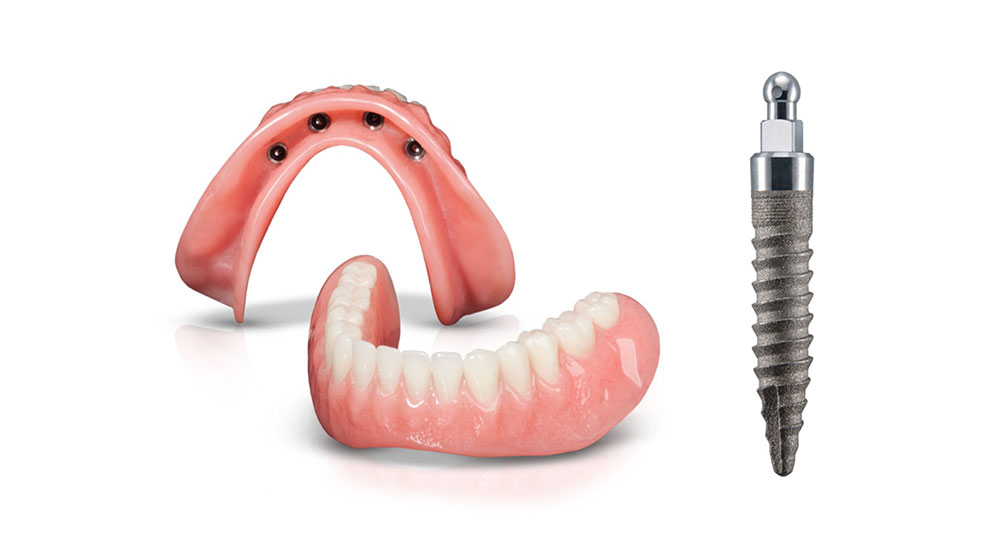 Mini Implant Overdenture