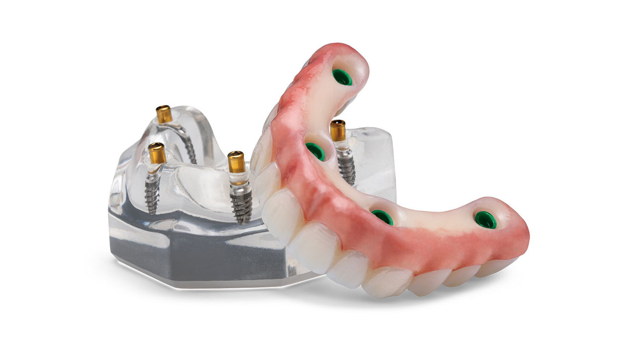 Locator Fixed Prosthesis