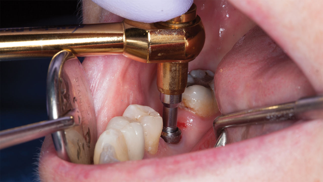 Freehand Implant Surgery