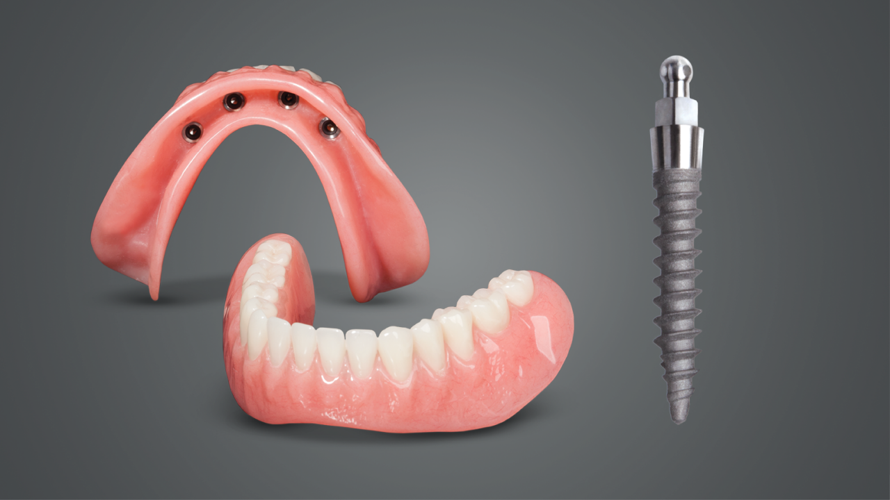 mini implant overdenture