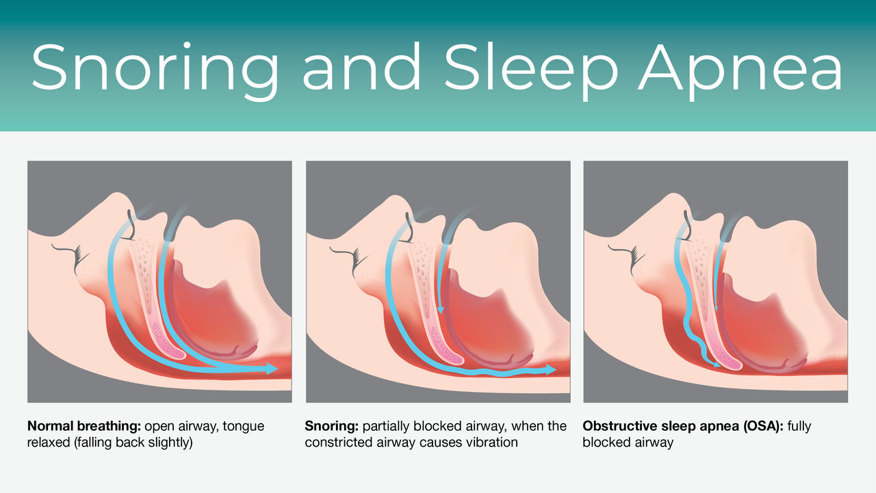 How Are Snoring and Sleep Apnea Different hero image