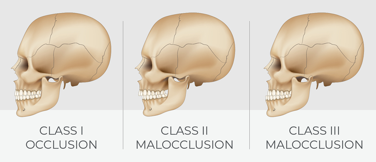 Types of dental occlusions by class