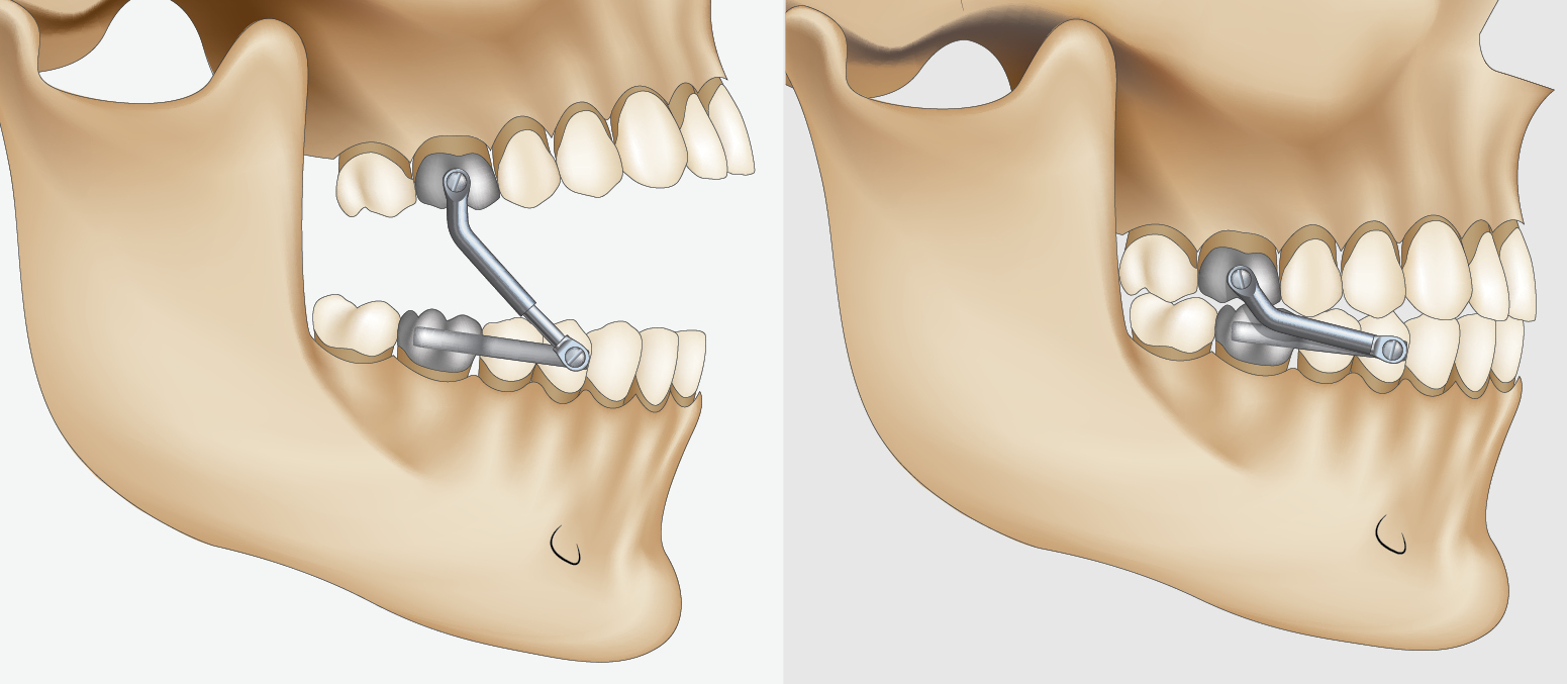 Herbst Appliance A Popular Snoring Device Glidewell