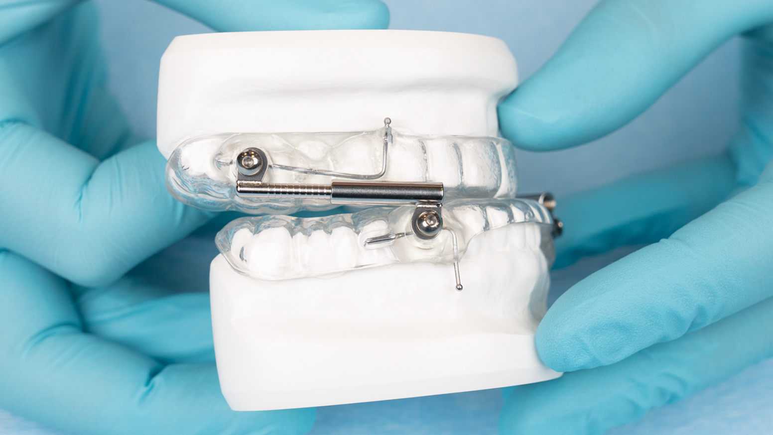 Herbst Appliance A Popular Snoring Device Glidewell