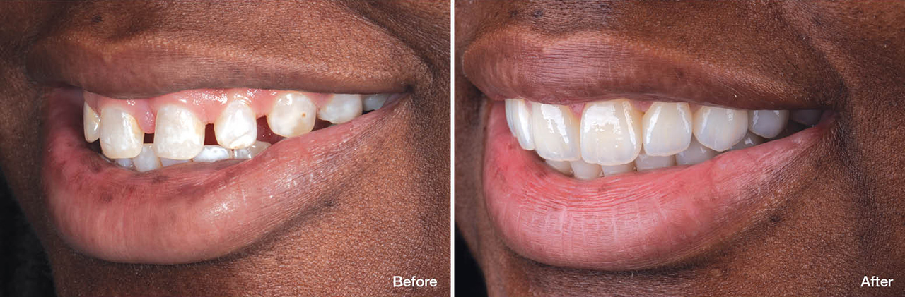 Before and after installation of BruxZir Esthetic zirconia crowns
