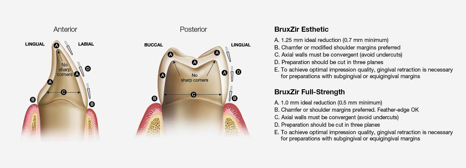 How to Choose Between Zirconia Crowns and IPS e.max® Crowns Glidewell