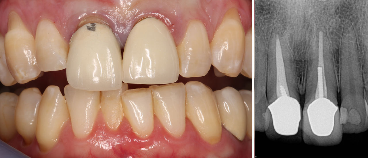 A fractured crown off the gumline