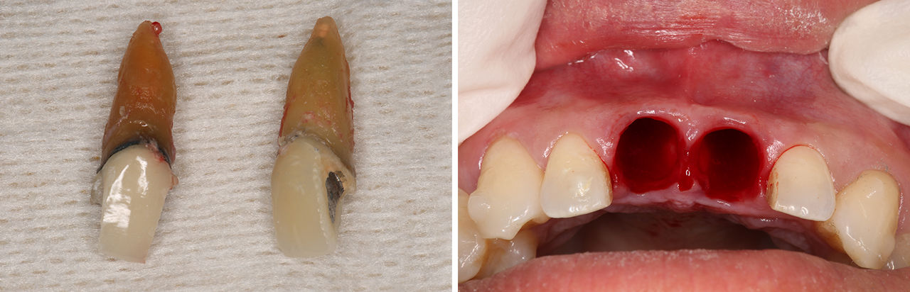 The patient’s central incisors were removed atraumatically