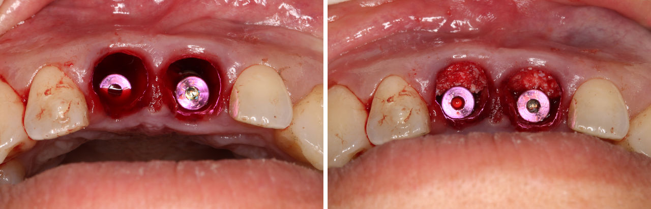 The implants were threaded into place by the Hahn Tapered Implant