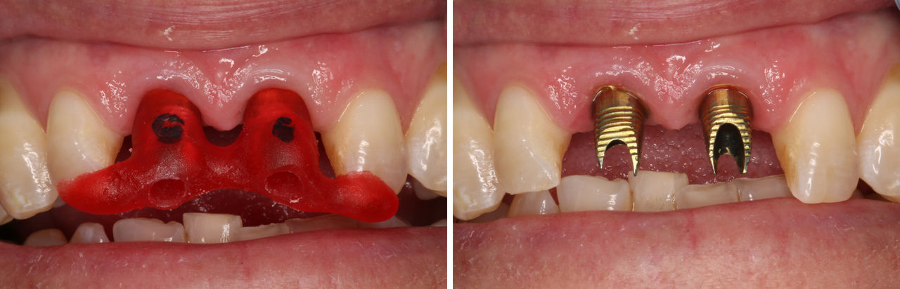 The gold-tone custom abutments placed using an acrylic delivery jig