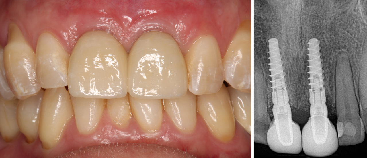 Final crowns delivered over the custom abutments
