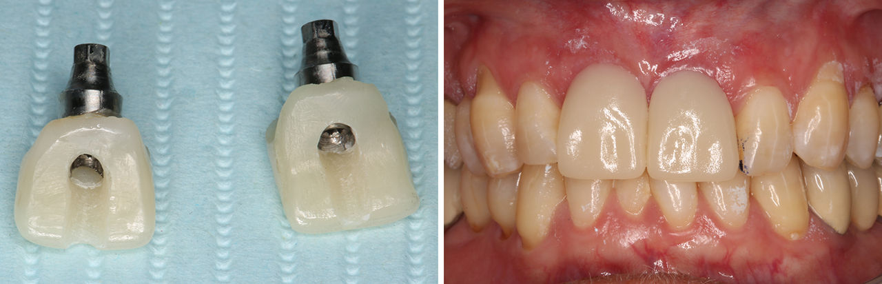 Hahn Tapered Implants installed providing excellent primary stability