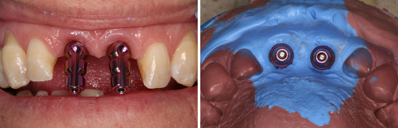 Closed-tray impression copings connecting to the Hahn Tapered Implants
