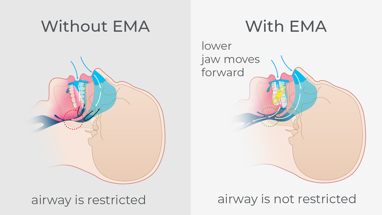 The EMA appliance is designed to both advance the mandible and open the bite to allow for less restricted airflow during sleep. 