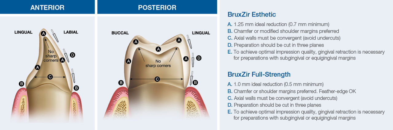 BruxZir Zirconia crowns allow for minimally prepared situations.