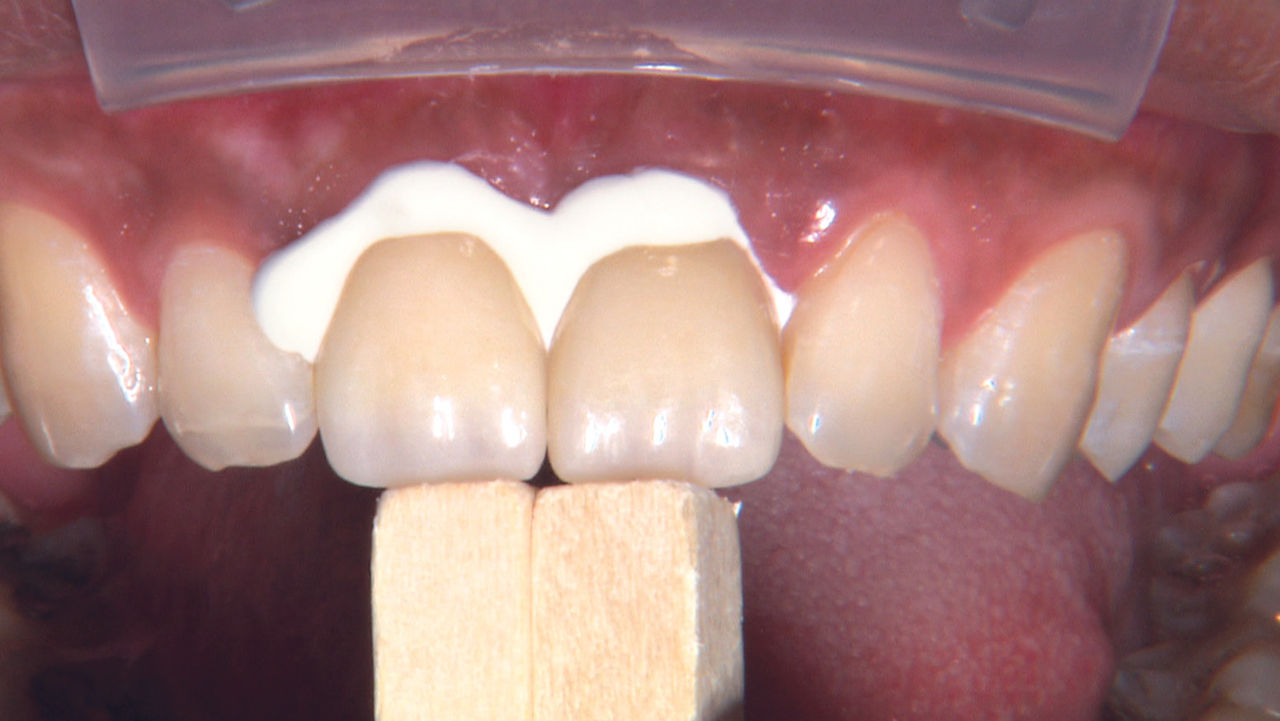 Dentists can choose between luting and bonding depending on what is best for the clinical situation at hand.