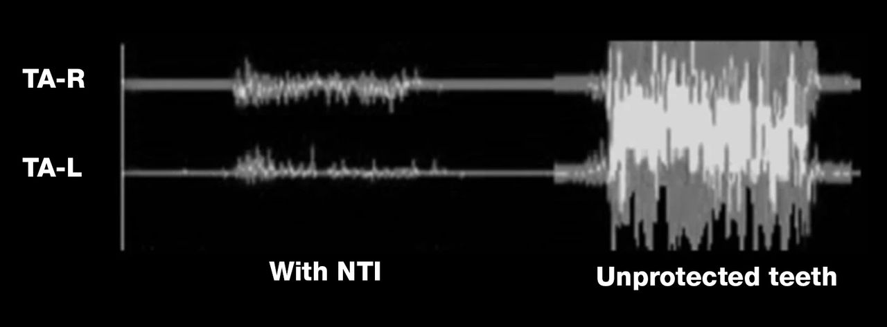 A recent NTI study confirmed that an NTI device can dramatically reduce clenching intensity in patients.