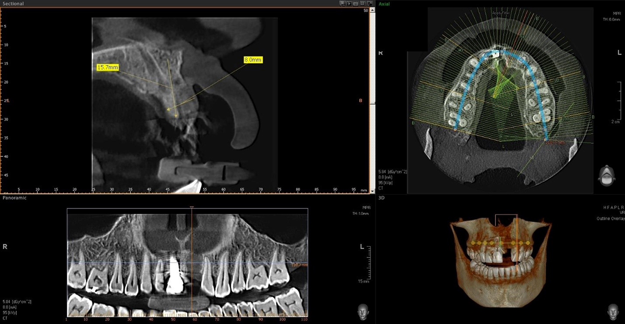 surgical implant x-ray image