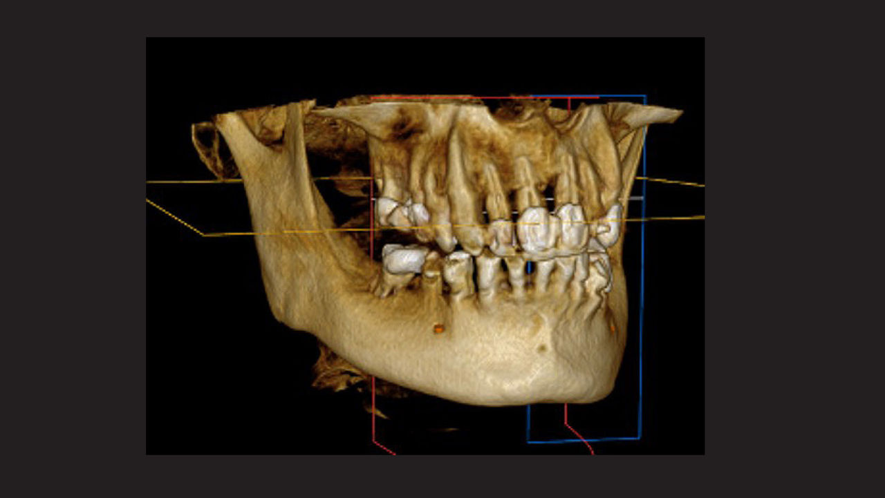 Preoperative CBCT image with a balanced voxel taken with patient out of occlusion