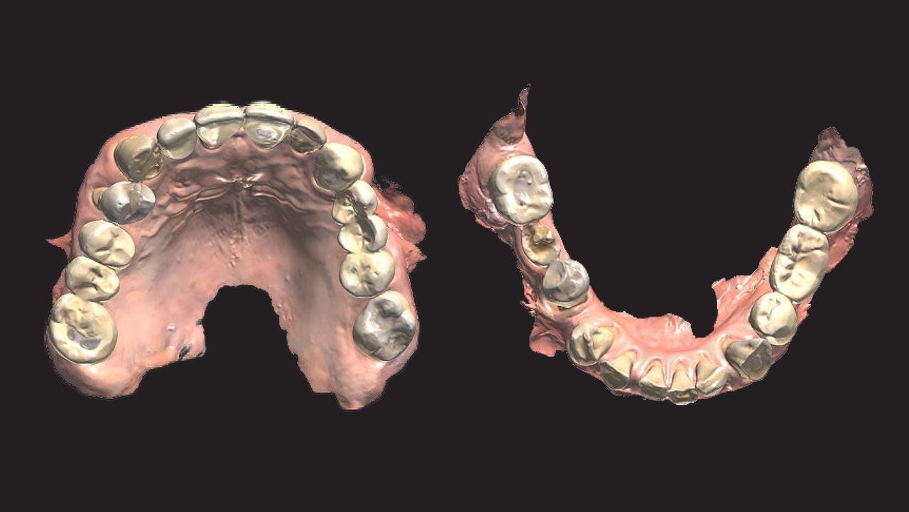 Preoperative intraoral scans showing upper and lower arches